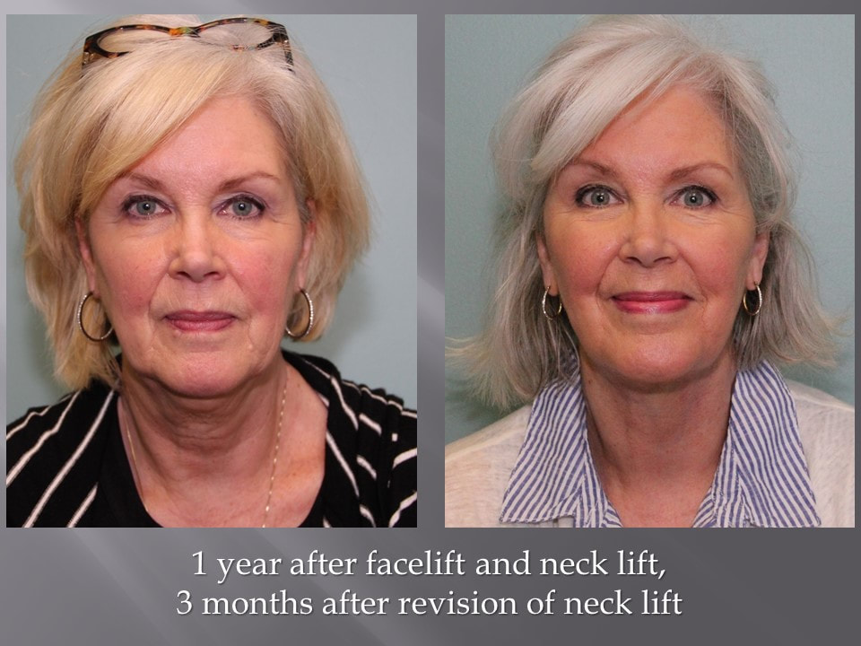 Face Lift and Neck Lift in Ohio