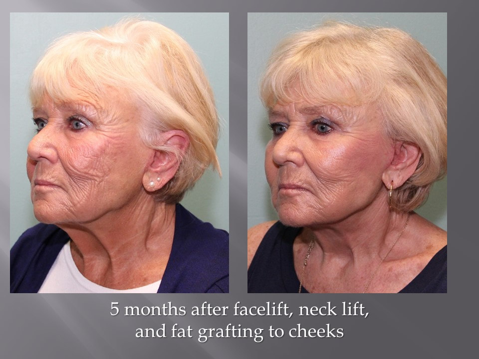Neck Lift and Facelift Ohio