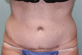 Mentor Body Surgery Results