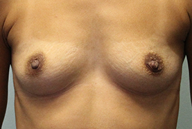 Mentor Breast Surgery