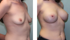 Breast Augmentation Gallery 1
