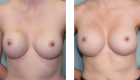Breast Augmentation Gallery-9