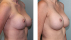 Breast Implants Removal in Mentor, OH