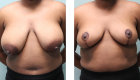 Breast Reduction-3