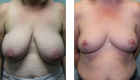 Breast Reduction-7