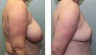 Breast Reduction-7