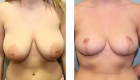Breast Reduction-9