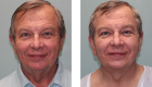 Face Lift & Neck Lift Gallery -1