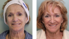 Face Lift & Neck Lift Gallery – 8