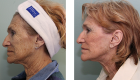 Face Lift & Neck Lift Gallery – 8