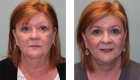 Face Lift & Neck Lift Gallery -2