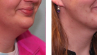 Face Lift & Neck Lift Gallery -10