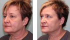 Face Lift & Neck Lift Gallery -3