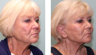 Face Lift & Neck Lift Gallery – 4