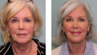 Face Lift & Neck Lift Gallery – 5