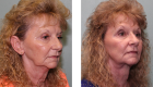 Face Lift & Neck Lift Gallery – 6