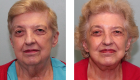 Face Lift & Neck Lift Gallery – 7