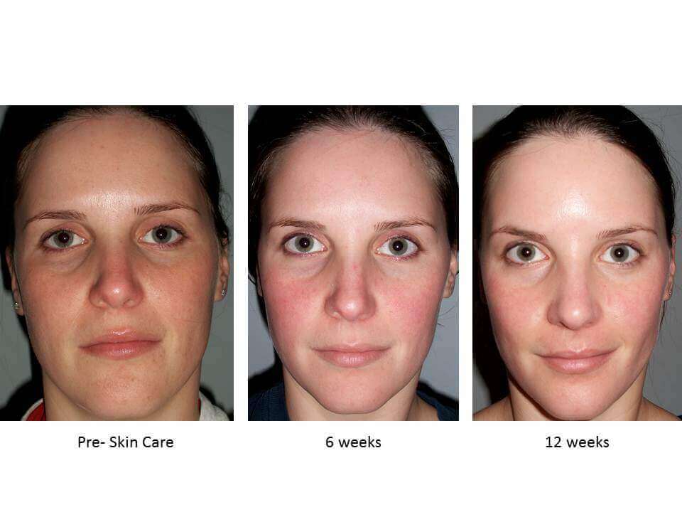 12 weeks of skin care regular use