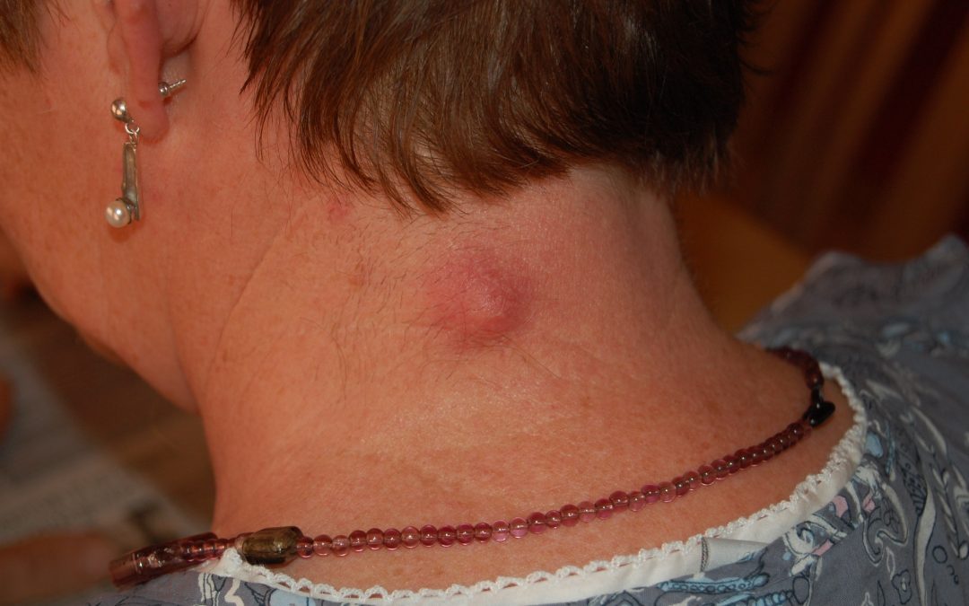 Why Does My Sebaceous Cyst Keep Coming Back?