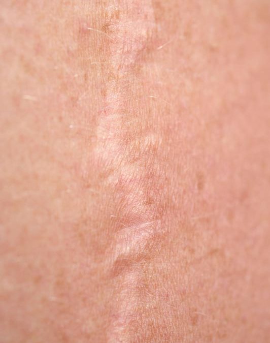 Making a Bad Scar Better