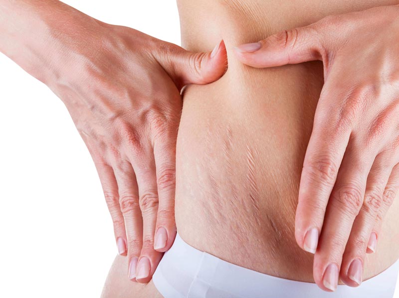 How to prevent stretchmarks