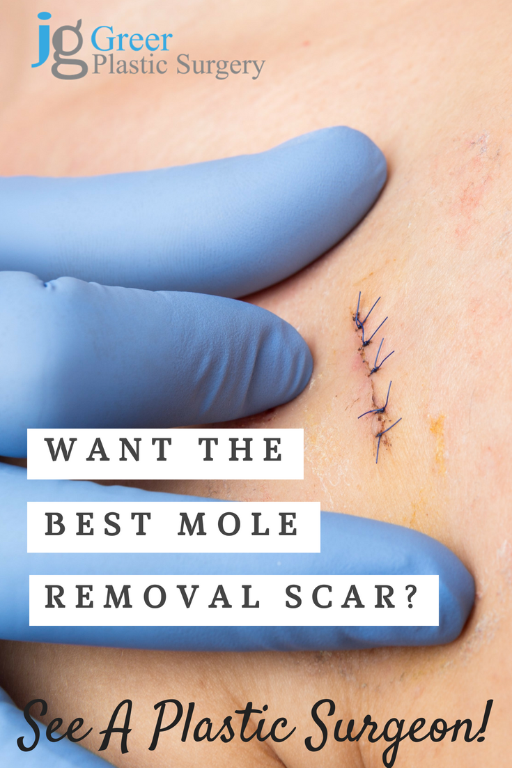 Mole Removal Scar