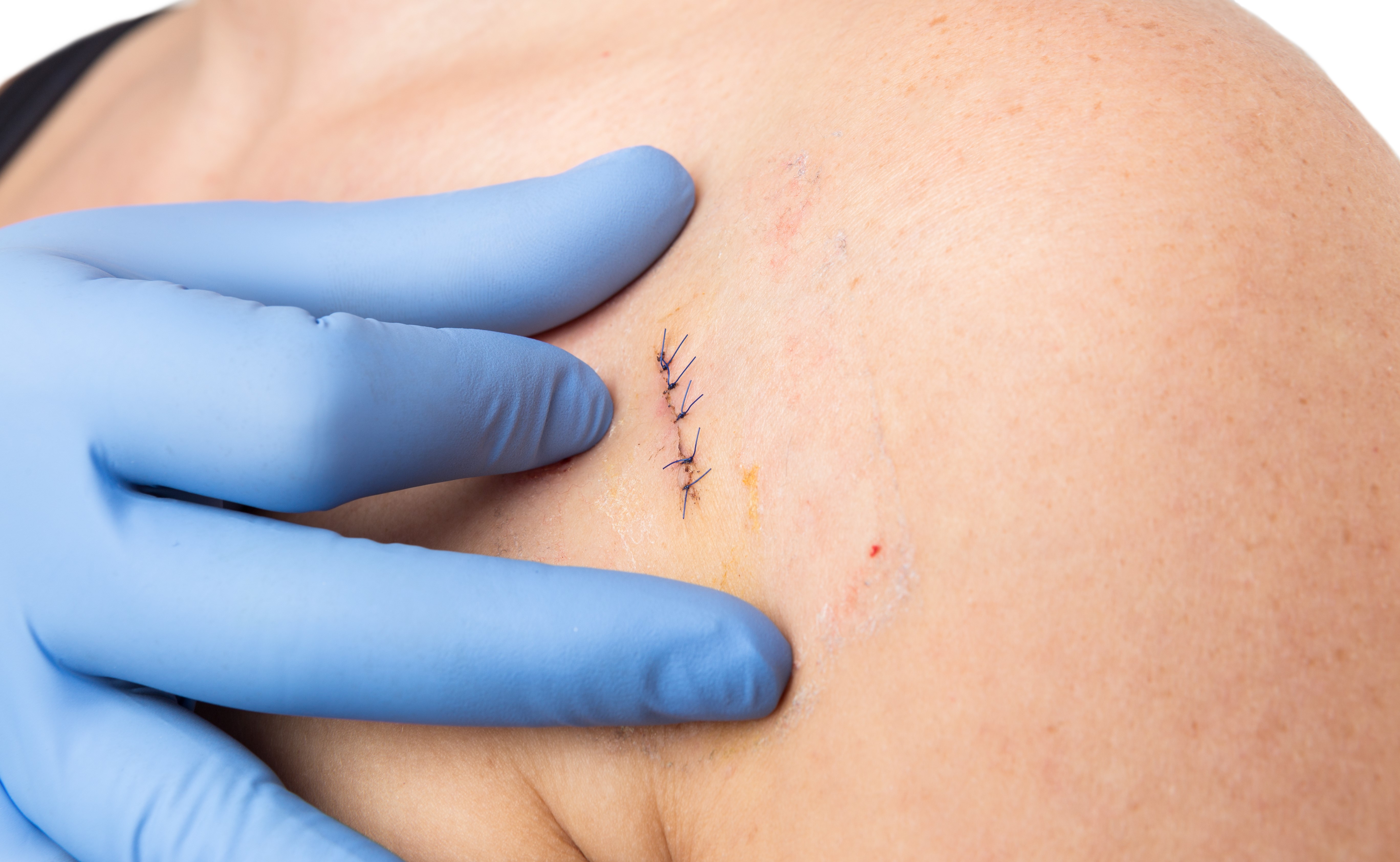 mole removal scar stitches