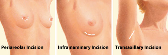 Breast Augmentation – where is the incision located?