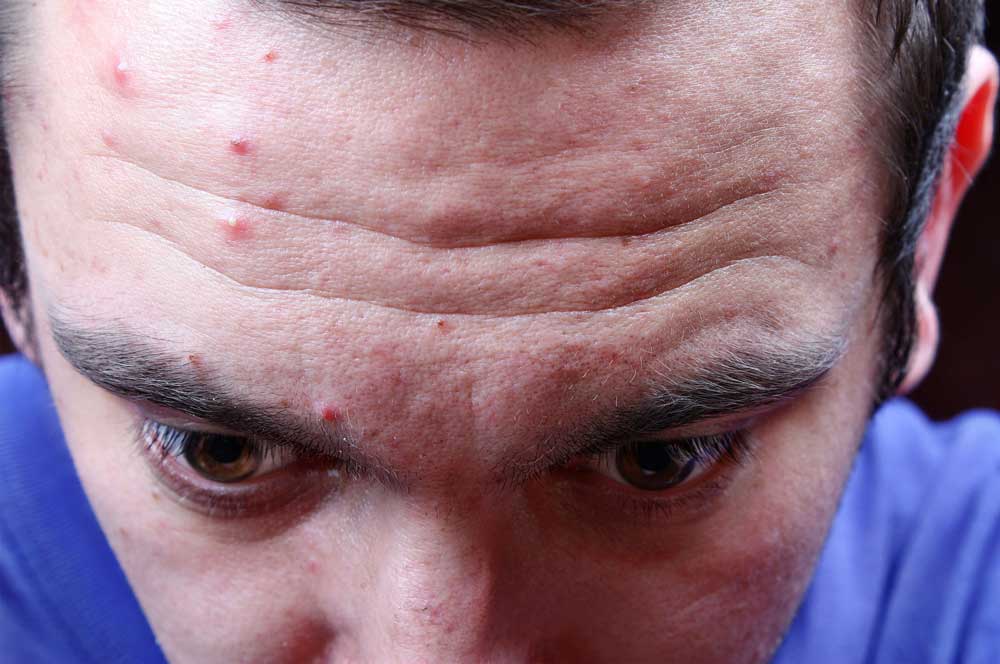 Is Acne Really a Medical Problem?