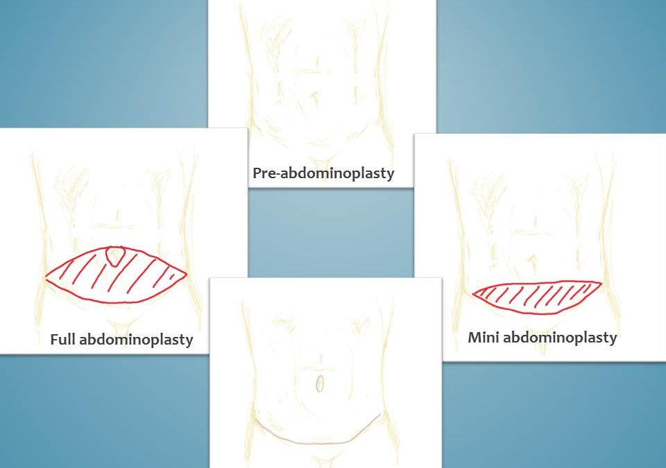 Abdominoplasty, Mini-Abdominoplasty- What’s the Difference?