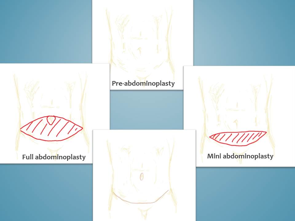 full abdominoplasty