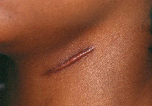 How Can I Make a Scar Less Noticeable?