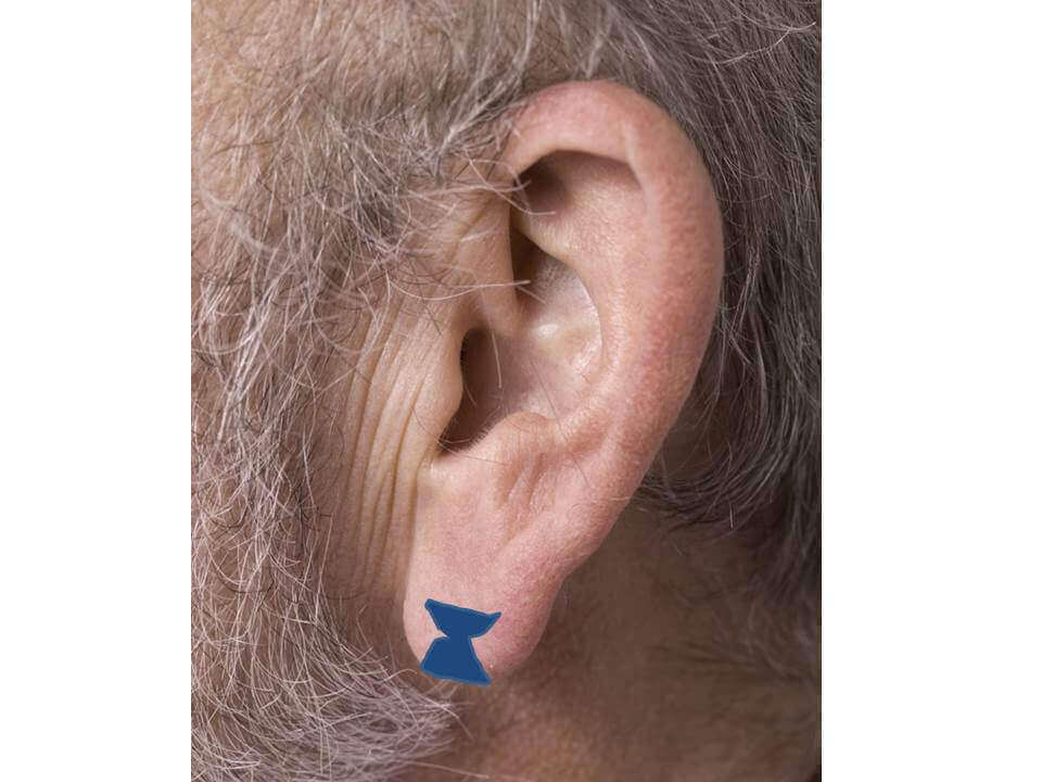 large earlobe treatment