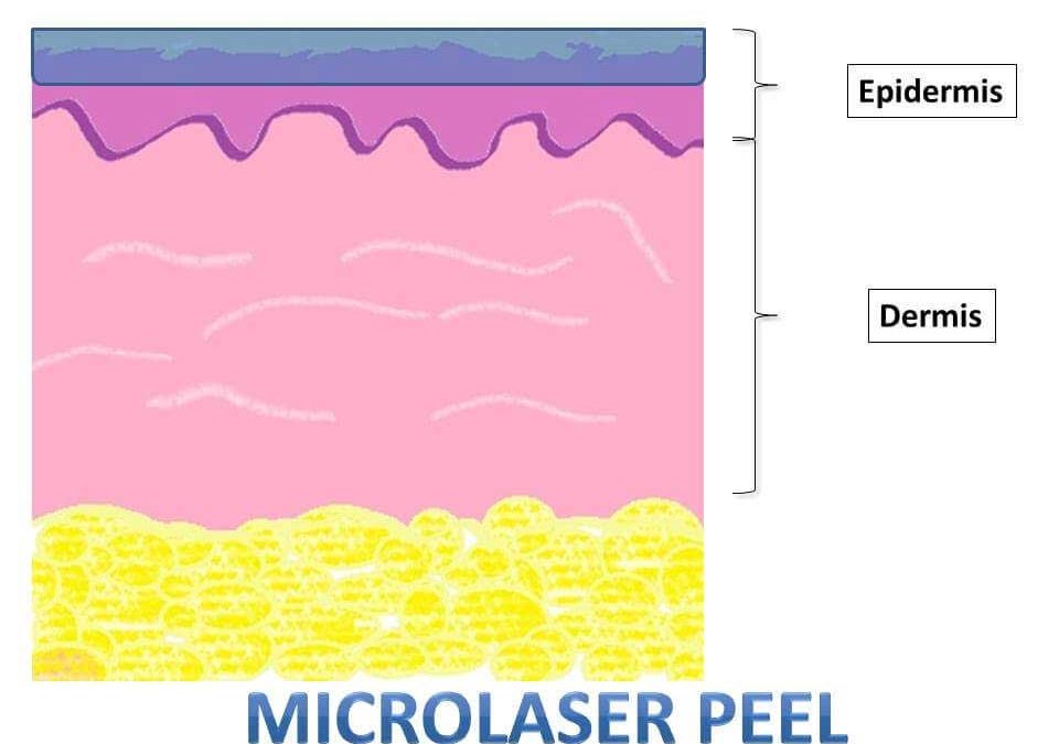Laser Resurfacing – The Complete Guide
