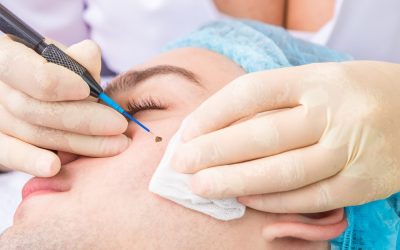 Want the best mole removal scar? See a plastic surgeon!
