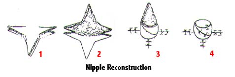 Nipple Reconstruction in Mentor OH