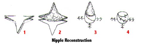 How is Nipple Reconstruction Done?