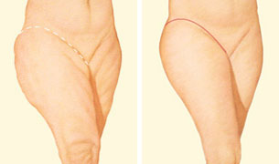 Outer thigh lift incision in Mentor, OH