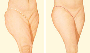 How is thigh lift surgery done?
