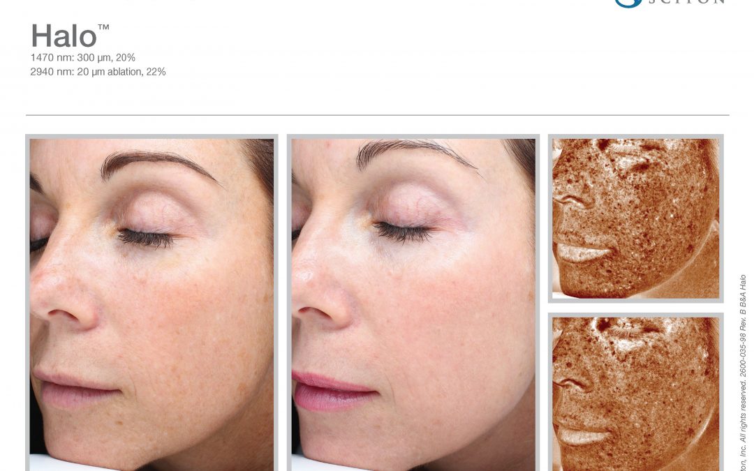 Halo laser – Better results with less downtime!