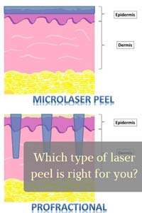 guide to laser peels