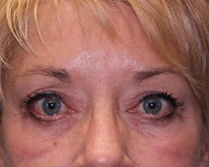 Before & After Eyes Lift