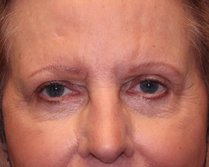 Before & After Eyes Lift in Mentor