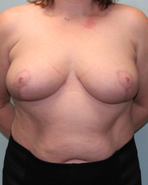 Breast Reduction in Mentor
