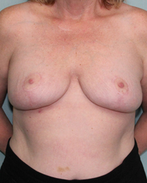 Breast Reduction in Mentor