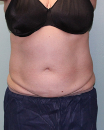 Before & After Coolsculpting in Mentor