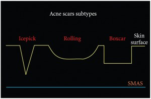 Types of depressed acne scars - thescienceofacne.com