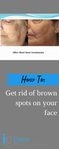 Get Rid of Brown Spots
