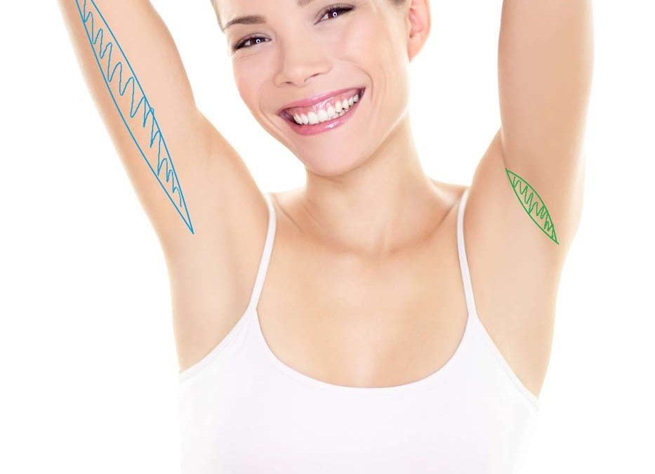 What is a Mini-Brachioplasty?