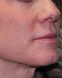 Before & After Non-Surgical Laser in Mentor